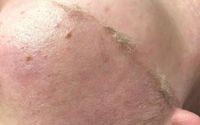 Mechanical Exfoliation by Let's Glow Skincare