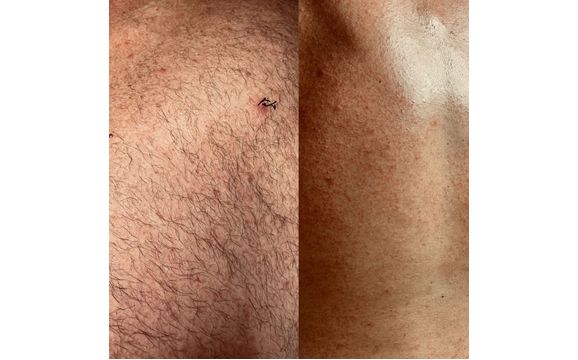 Leg & Bikini Waxing by Renu-U Specialized Skin Care Studio