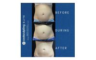 CoolSculpting non surgical fat reduction  by  The Spa MD