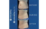CoolSculpting Non-Surgical fat reduction by  The Spa MD