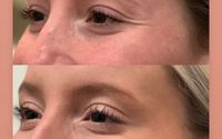 Muscle Relaxers for Crows Feet  by Lumina Skin and Laser