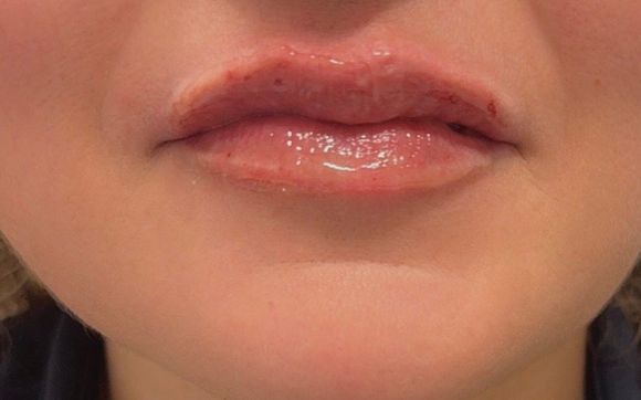 Lip fillers, Botox, microneedling  by Belles Gens Laser & Spa, LLC