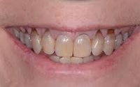 Pinhole Surgery by Mega Bite Dental - Mojgan Shokri, DDS