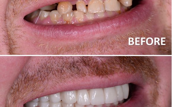 Dental Implants by Dr. Lucy Slutsky, DMD