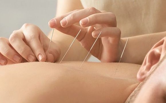 Acupuncture & Dry Needling by Transcendence Health