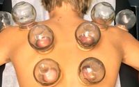 Cupping by Transcendence Health