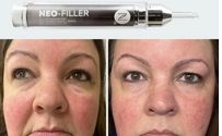 Neo filler by Neora Skincare and wellness