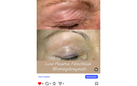 Luxe Plasma Fibroblast by Honeydew Youth