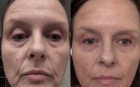 Neofiller by Neora Skincare and wellness
