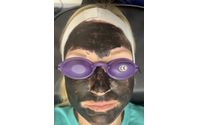 Carbon Peel Laser Facial  by Later Laser