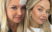 Natural Treatments by Amy Davis, RN, BSN - Aluma Medical Aesthetics