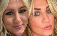 Botox injections  by Amy Davis, RN, BSN - Aluma Medical Aesthetics