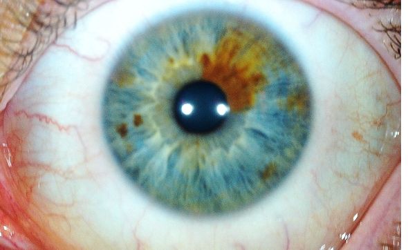Iridology Analysis by Eyespy Iridology & Wellness