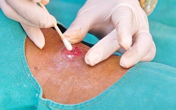 Wound Swabbing by Faith Driven Leader