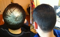 Hair Replacement For Men by Suisse Natural Hair Salon