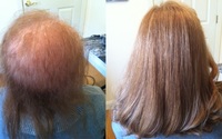 Hair Replacement For Women by Suisse Natural Hair Salon