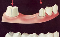 FIXED BRIDGE by New York Ave Dental PC