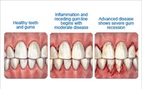 GUM TREATMENT by New York Ave Dental PC