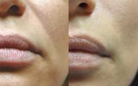 Facial Fillers & Botox by The Vein Doctor Medical Group