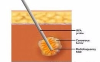 Tumor Ablation & Kyphoplasty by Jay Taddei
