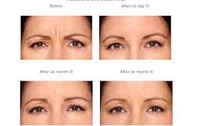 BOTOX  by Natura Plastic Surgery [Dr. Hector Salazar-Reyes]