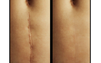 Scar Tissue Reduction Therapy by Pain & Swelling Solutions Lymphatic Massage for Plastic Surgery Recovery