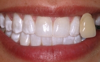 KOR  Max Whitening  (Once started in 3 weeks Awesome White teeth) by SmileSketchVegas.com