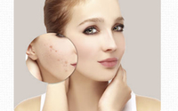 Skin Care Treatments (for all skin types) by Reflections Laser and Wellness Center