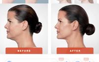 Kybella by ReSolutions Med Spa and Chiropractic: Lesa Ansell DC, APRN, AGNP-C, LHR-T
