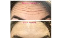 Dysport/Botox by Refresh Aesthetics Columbus, OH-MedSpa
