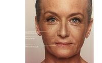 Dermal Fillers (Restylane/Juvéderm) by Refresh Aesthetics Columbus, OH-MedSpa