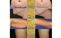 Cutera TruSculpt 3D by Refresh Aesthetics Columbus, OH-MedSpa