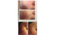 Cutera Laser Genesis by Refresh Aesthetics Columbus, OH-MedSpa