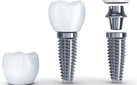 Dental Implants by Dental Health Care of Woburn, P.C.