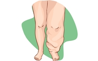 Lymphedema Treatment by Pain & Swelling Solutions Lymphatic Massage for Plastic Surgery Recovery