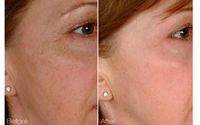 Laser Skincare Rejuvenation and Fat Reduction Contouring by Natural Balance Massage and Wellness Center