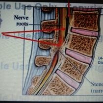 Non-surgical spinal decompression by Spine PRO Chiropractic