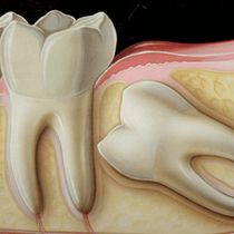 WISDOM TEETH EXTRACTION & REMOVAL  by Paris Family Dental