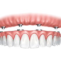 Teeth in a day Dental Implant services in Paris TX by Paris Family Dental