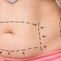 San Diego Tummy Tuck by Restore SD Plastic Surgery: Katerina Gallus, MD, FACS